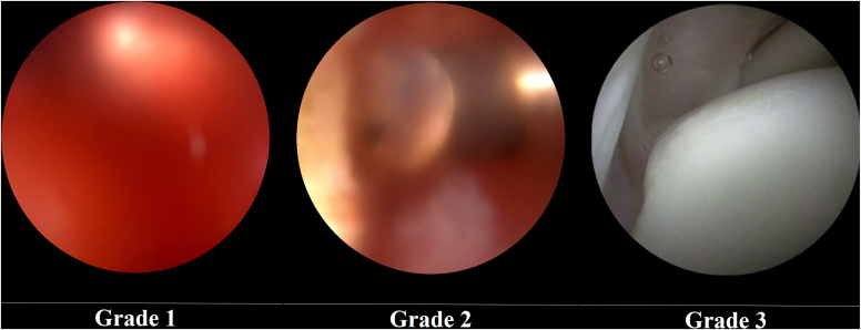 Paper figure showing three grades of shoulder arthroscopic visual clarity relative to bleeding
